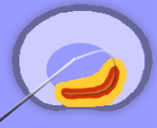 IDET (Intradiscal Electrothermal Annuloplasty)