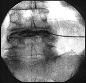 Thermische Bandscheibenfestigung