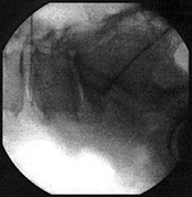  Nucleoplastie - Neue Therapie beim Bandscheibenvorfall