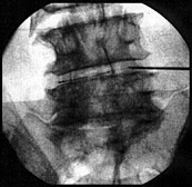 Thermosonden-Behandlung der Wirbelgelenke